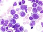 <b>Chronic Myelomonocytic</b>