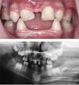 <b>Ectodermal dysplasia</b> - Wikipedia, the free encyclopedia