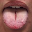 Herpes simplex virus (HSV) [OzEmedicine - Wiki for Australian ...