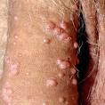<b>disease Genital</b> Warts