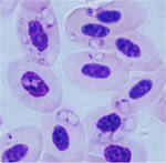 <b>Babesiosis</b> - Causes, Symptoms, Diagnosis and Treatment