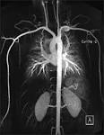 MR <b>angiography</b> of the hand