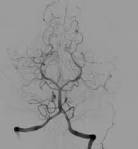 File:Cerebral <b>angiography</b>