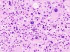 File:Primary aldosteronism (2) <b>adrenocortical adenoma</b>.jpg