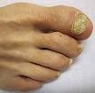 <b>Onychomycosis</b> - Wikipedia