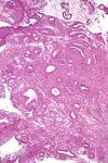 File:Simple <b>endometrial hyperplasia</b> - intermed mag.jpg - Wikipedia