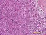 A child with giant cell tumor of tendon sheath