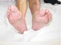 <b>Foliculitis</b> Pustulosa