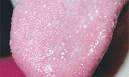Why do I get a little bump on the tip of my tongue when I eat