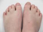 simple <b>syndactyly</b>.jpg