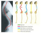 Hyper-<b>Lordosis</b> in Children