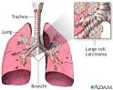 <b>Lung cancer</b> - <b>non</b>-<b>small cell</b>;