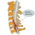What are the Symptoms of Lumbar SPINAL STENOSIS