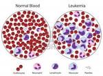 <b>Leukemia</b> is not an inherited