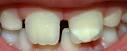 <b>Hipoplasia</b> del <b>Esmalte</b>.-