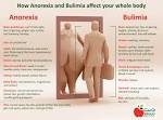 <b>Bulimia</b> nervosa, characterized