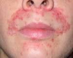 <b>Dermatite</b> périorale www.guide-acne.fr