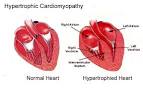 Medical Blog » Blog Archive » Cardiomyopathy, Hypertrophic