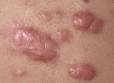 Treating <b>Keloid Acne</b> Scars: