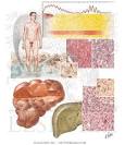 <b>Weil's Disease</b>, Syphilis
