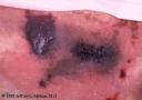 <b>Protein C deficiency</b>