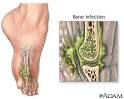 What is <b>Osteomyelitis</b> and