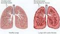 Cystic Fibrosis - body, causes, What Is Cystic Fibrosis?