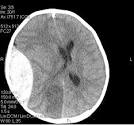 <b>Intracranial Hemorrhages</b>