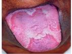 migratory <b>glossitis</b>.