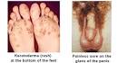 <b>Reiter's Syndrome</b> - Symptoms And Signs | Medindia
