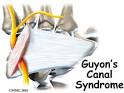 Guyon's canal <b>syndrome</b> is an