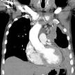 Left sided <b>mesothelioma</b> with