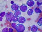 File:<b>Burkitt lymphoma</b>, touch prep, Wright stain.jpg - Wikimedia