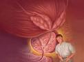La <b>prostatitis</b> es sinónimo de