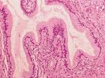 <b>Uterine cervicitis</b>.
