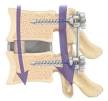 <b>Spinal Fusion</b>