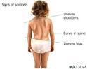 The treatment of <b>scoliosis</b> can