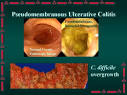 Clostridium difficile- Pathology