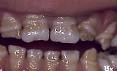 <b>Hipoplasia</b> del <b>esmalte</b>.