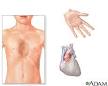 of marfan syndrome