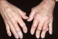 <b>Gout</b> - Cedars-