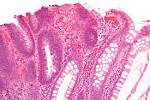 File:Tubular <b>adenoma</b> 2 high