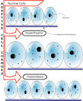 vs <b>Hypertrophy</b>.svg