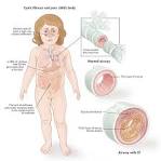 Cystic <b>Fibrosis</b> - Symptoms, Tests, Treatment