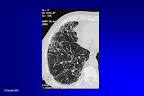 <b>asbestose</b> au scanner