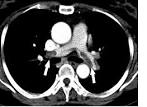 File:<b>Pulmonary embolism</b>.jpg - Wikimedia Commons