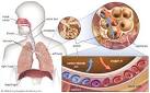 as respiratory <b>acidosis</b> or