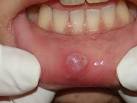 de <b>doenças</b> da <b>boca</b>