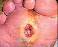 Typical <b>diabetic foot</b> ulcer