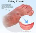 Picture of Pitting <b>Edema</b>